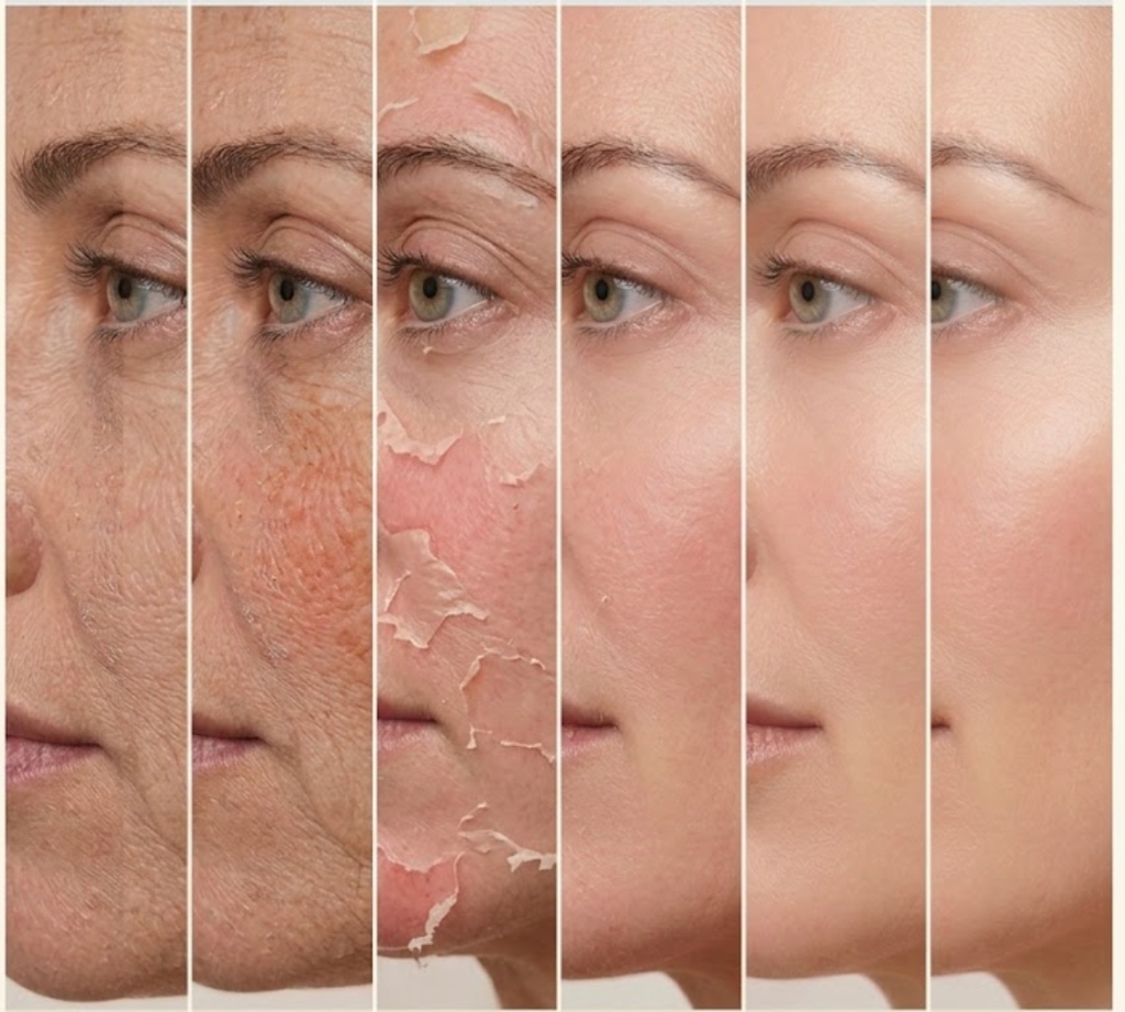 Medical Grade Chemical Peels