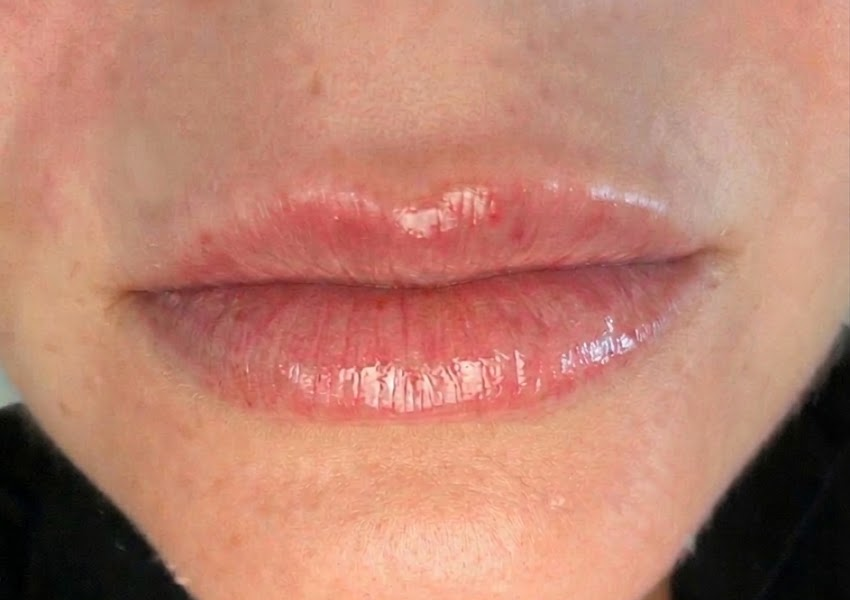 Dermal Fillers (Juvederm & Restylane)