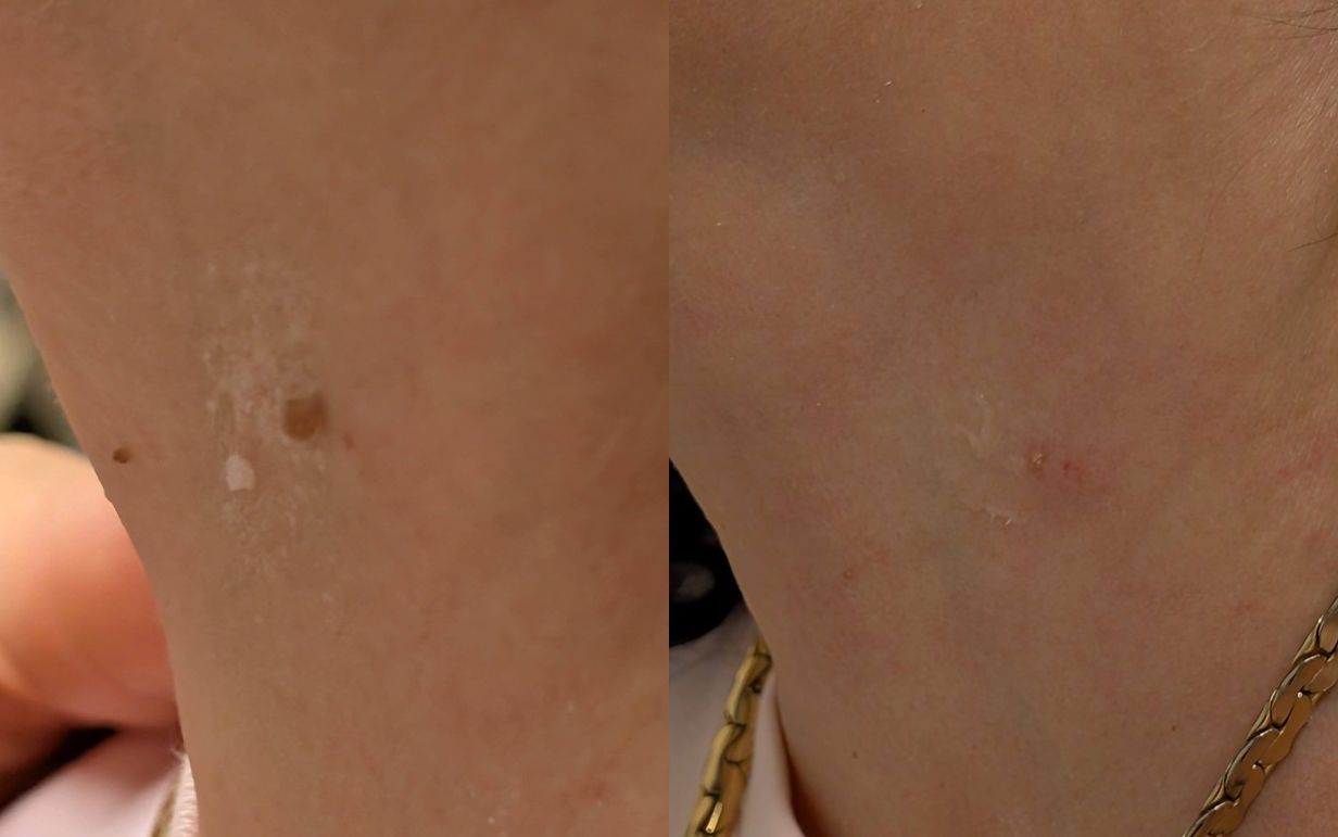 Skin Tag Removal