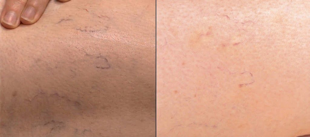 Spider Vein Removal